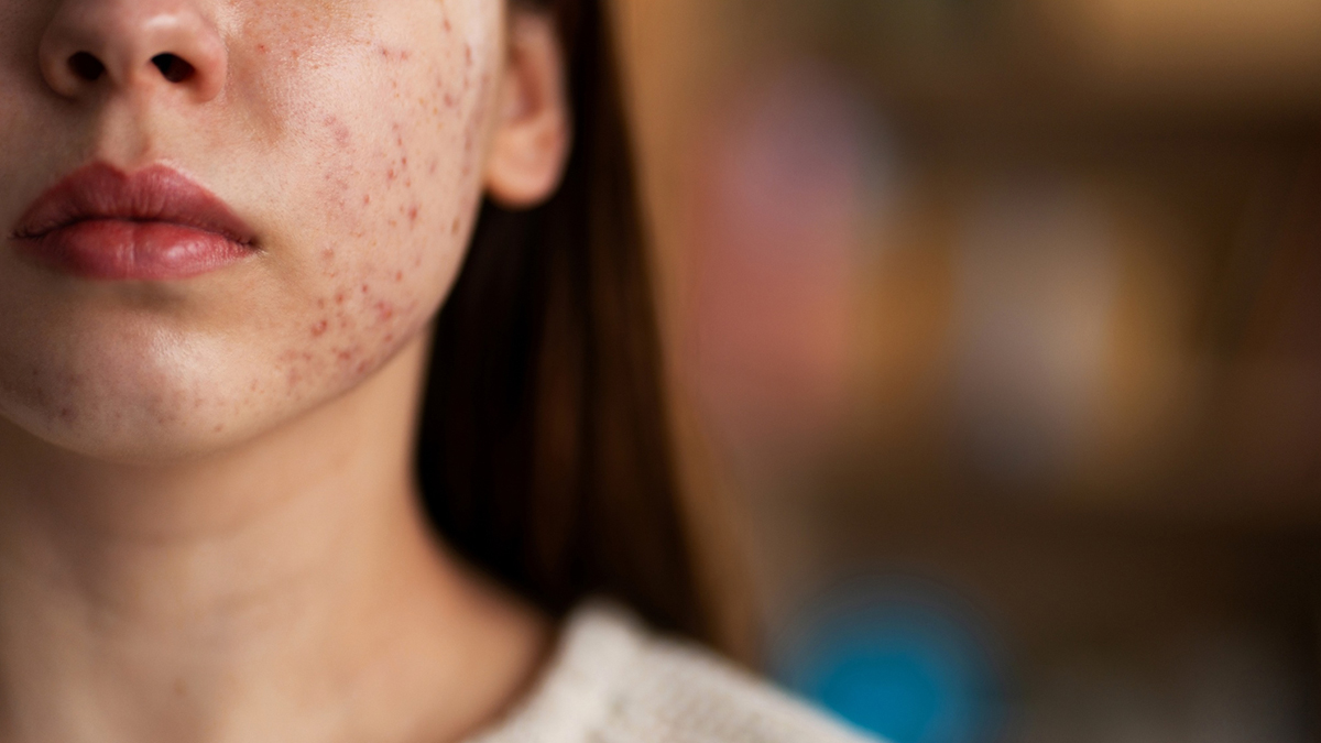 Person with acne on her face